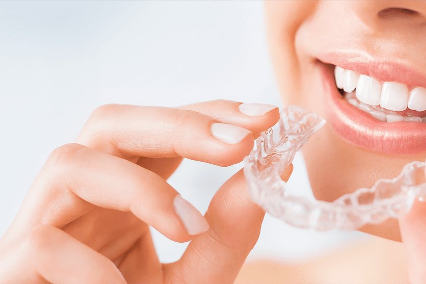 Aligner Behandlungen