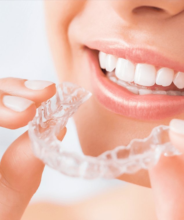 Aligner Therapie
