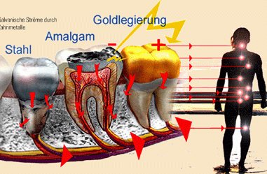 Störfeldsanierung / Amalgamentfernung